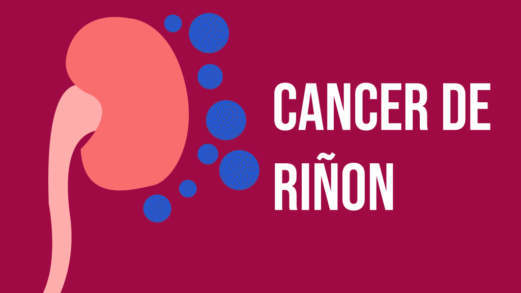 Cáncer en riñón – Dr. Mario Doria