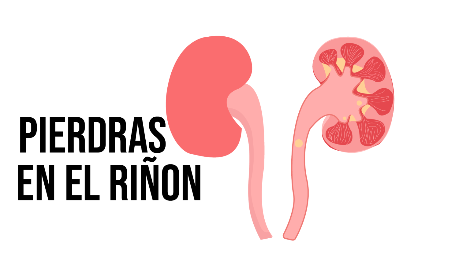 Piedras en riñón – Dr. Mario Doria